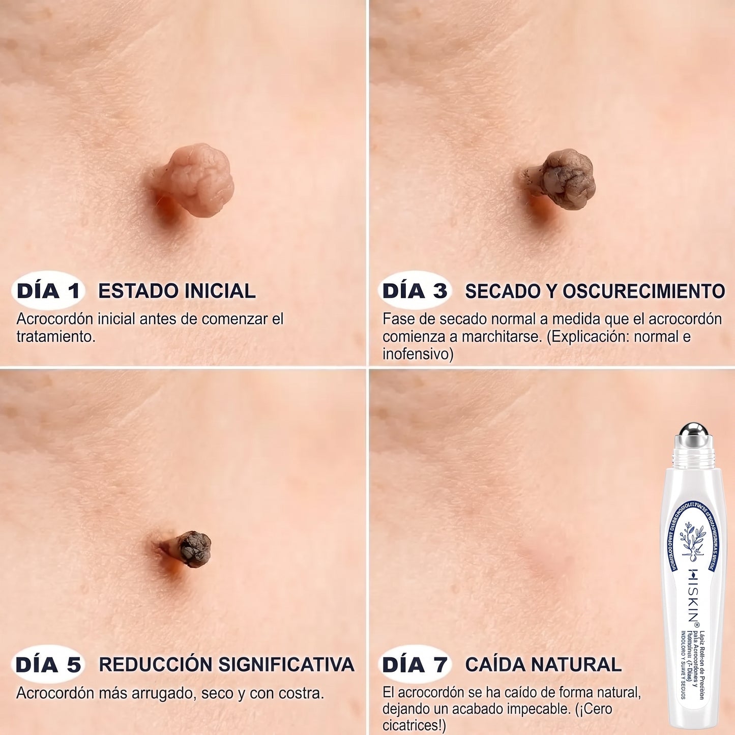 𝐇𝐈𝐒𝐊𝐈𝐍®👩‍⚕️ 𝟕-𝐃𝒂𝘆 𝐒𝗸𝐢𝐧 𝐓𝒂𝗴 & 𝐒𝐩𝙤𝐭 𝐄𝐫𝒂𝐬𝙚𝐫 Sans douleur & Scar-Free Advanced Imperfection Removal Rollerball Pen