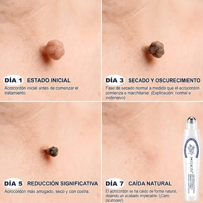 𝐇𝐈𝐒𝐊𝐈𝐍®👩‍⚕️ 𝟕-𝐃𝒂𝘆 𝐒𝗸𝐢𝐧 𝐓𝒂𝗴 & 𝐒𝐩𝙤𝐭 𝐄𝐫𝒂𝐬𝙚𝐫 Sans douleur & Scar-Free Advanced Imperfection Removal Rollerball Pen