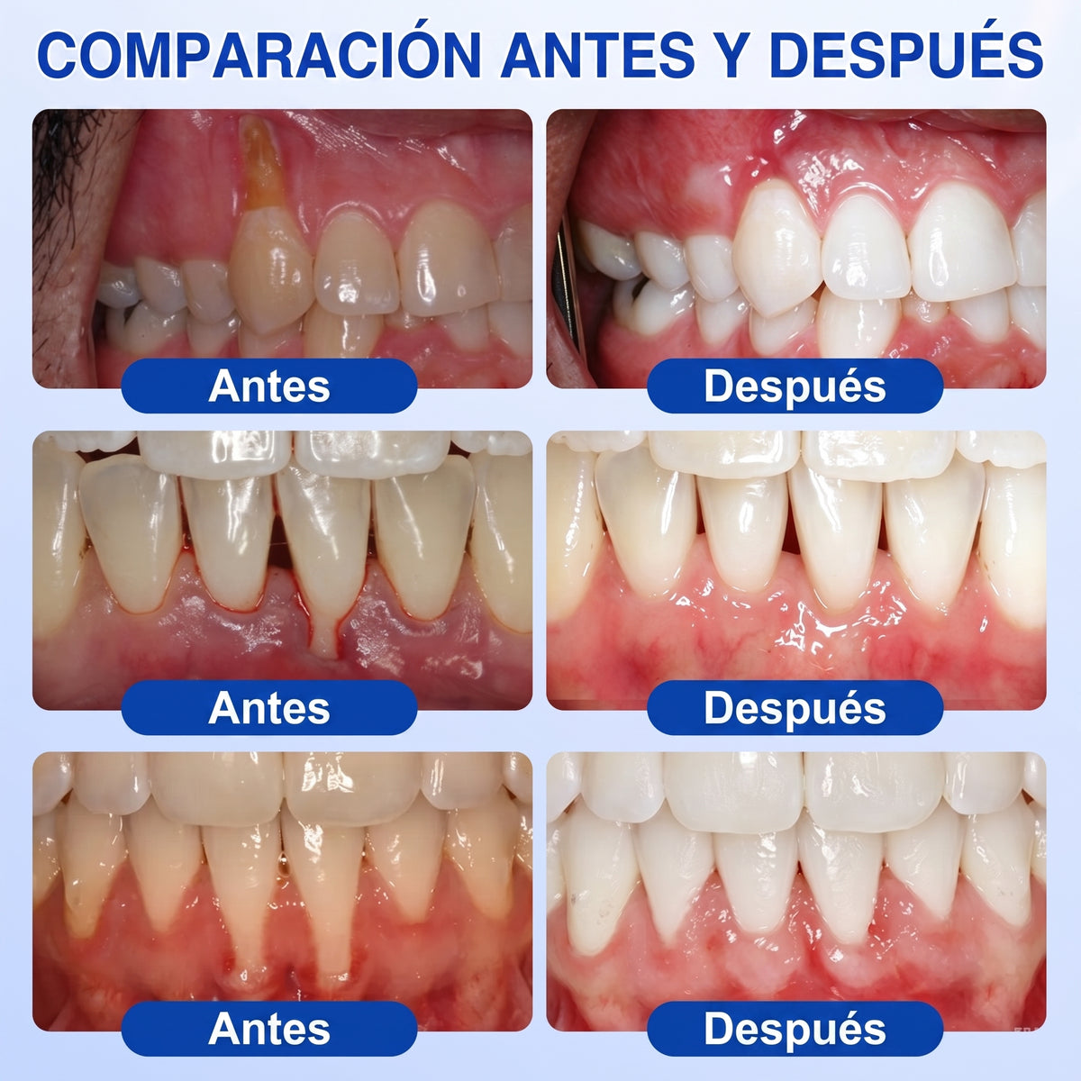𝐇𝐈𝐒𝐊𝐈𝐍®👩‍⚕️🇪🇸🏅🦷🛡️ HISKIN® GumRevive Gel Reparador Periodontal