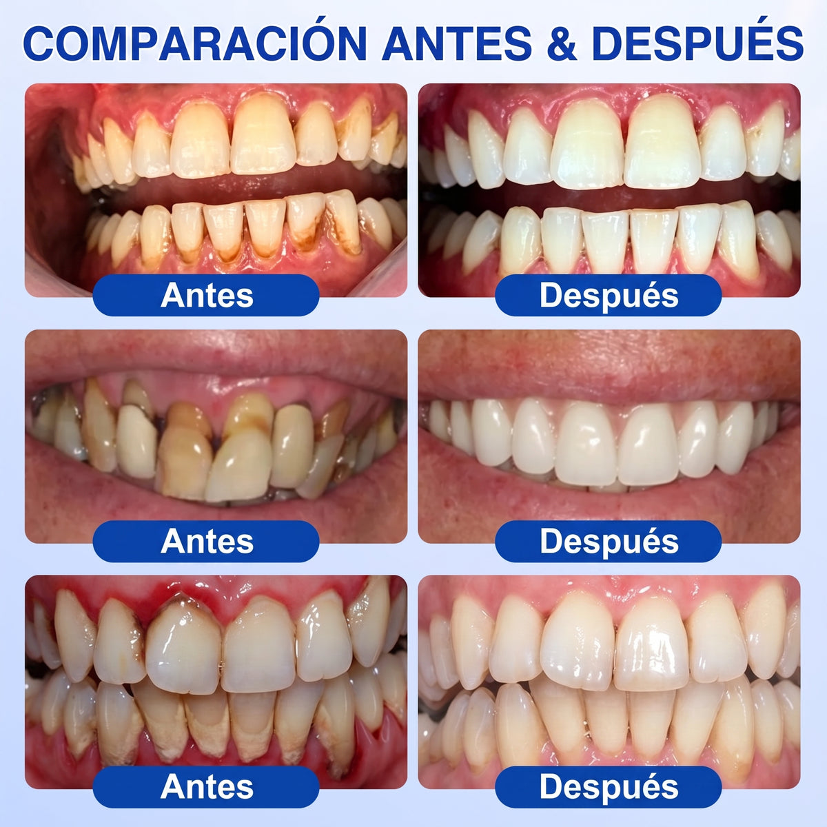 𝐇𝐈𝐒𝐊𝐈𝐍®👩‍⚕️🇪🇸🏅🦷🛡️ HISKIN® GumRevive Gel Reparador Periodontal